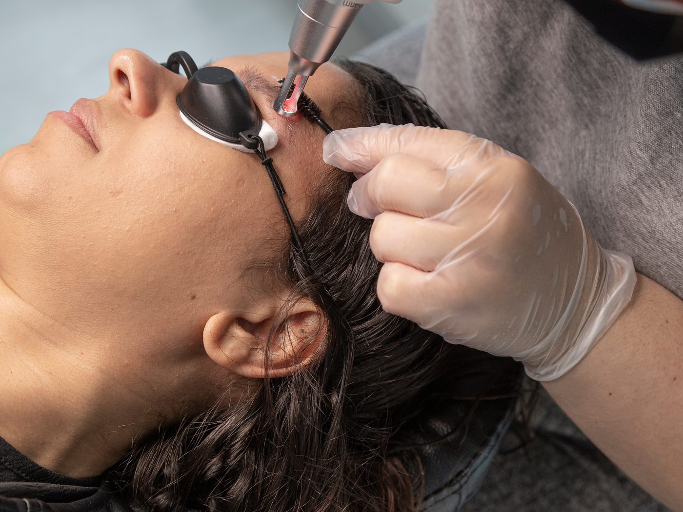 Brow removal — lightening previous work with laser